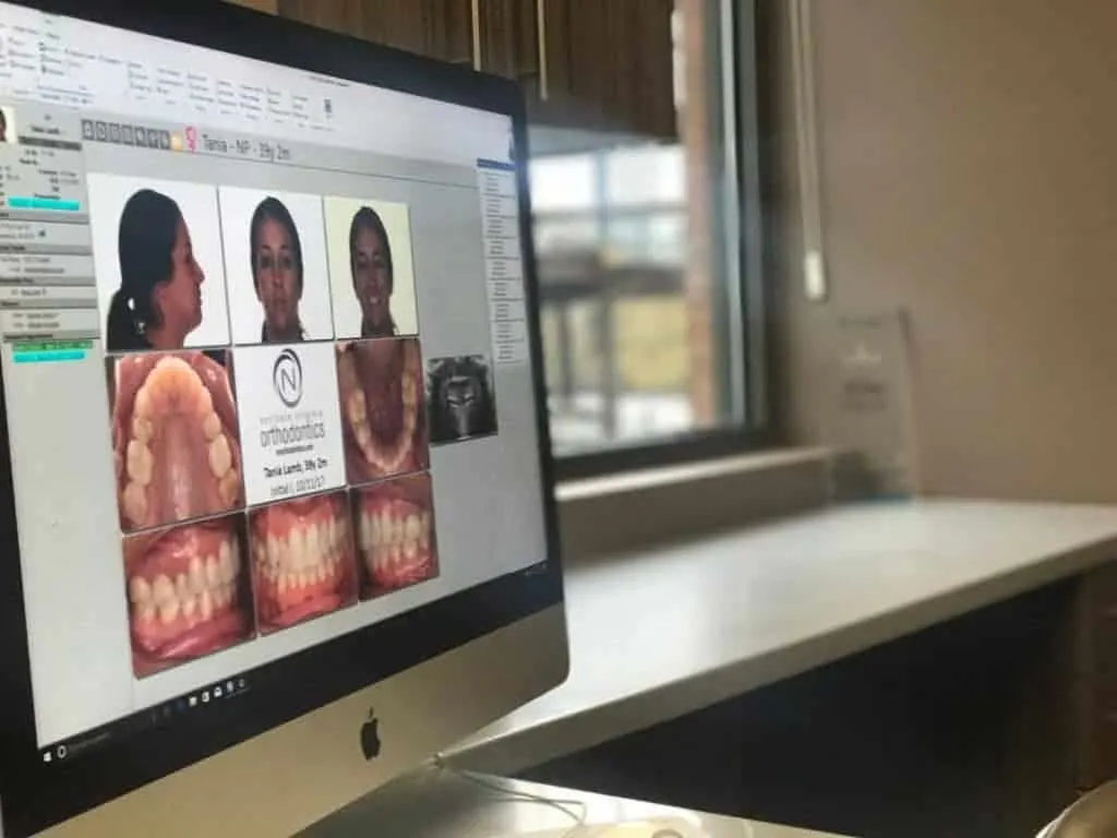 Before Invisalign scanning, you need x-rays to see if your teeth and roots are healthy.