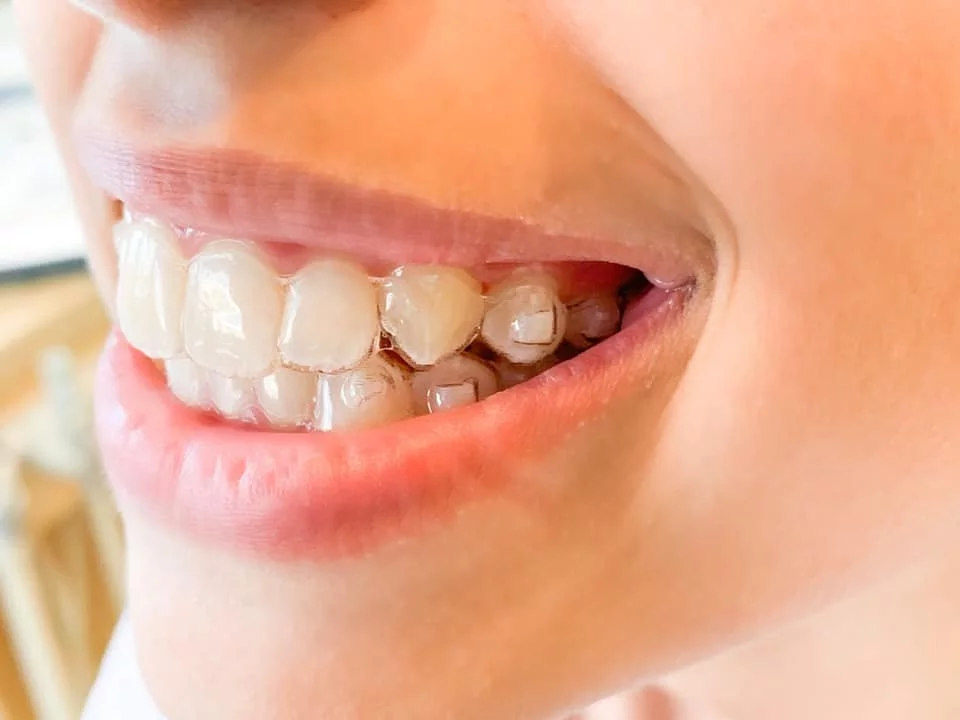 Invisalign attachments